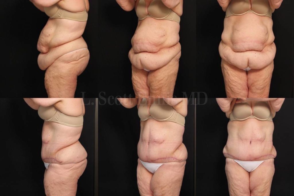 51yo 5'5'' 226lb Abdominoplasty after massive weight loss