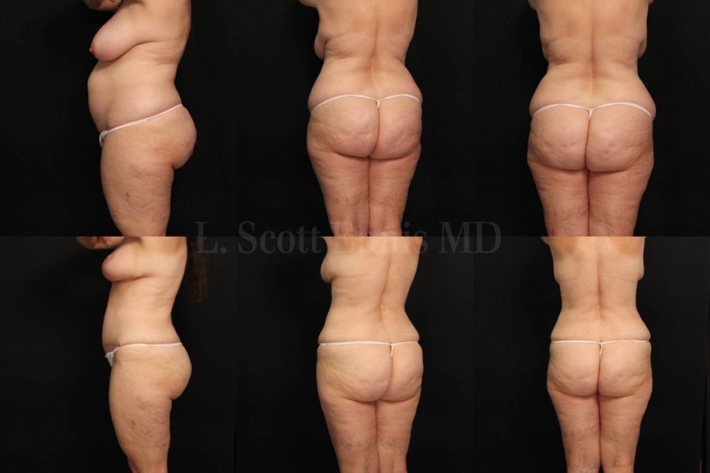 55yo 5'1'' 156lbs Liposuction of Hips