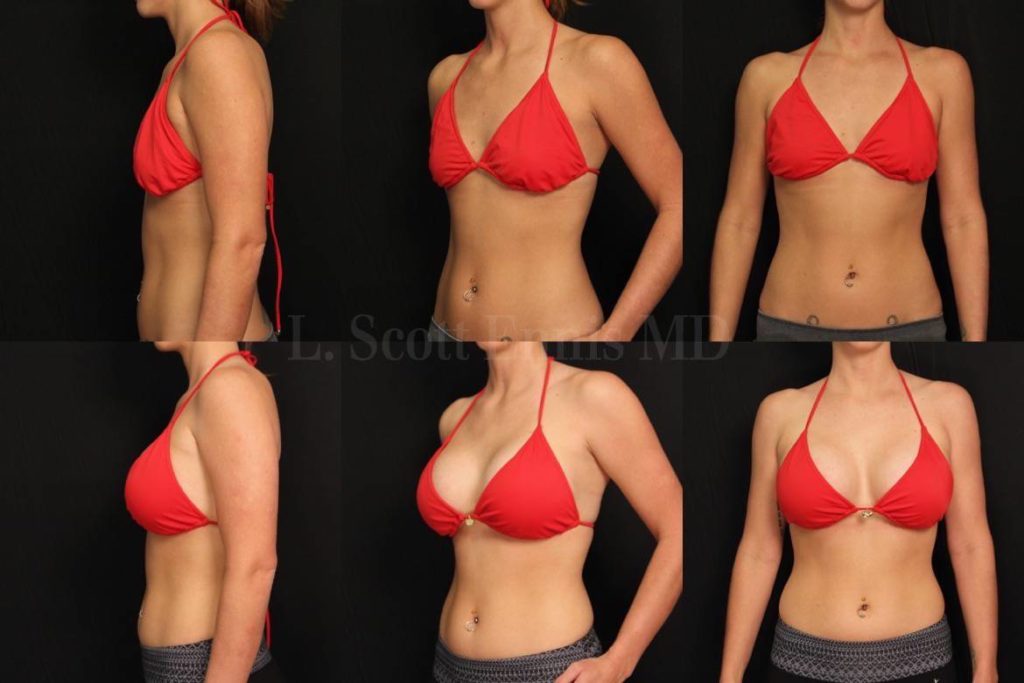 Smaller Cup Size And Natural Look Breast Augmentation Trend-1172