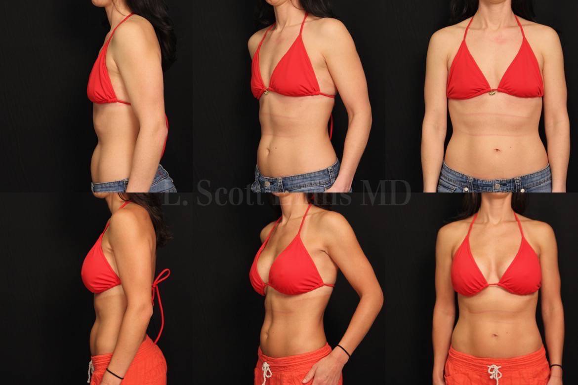 beca-breast-augmentation-35yo 5'4' 125lbs B to a C Sientra Mod plus gel