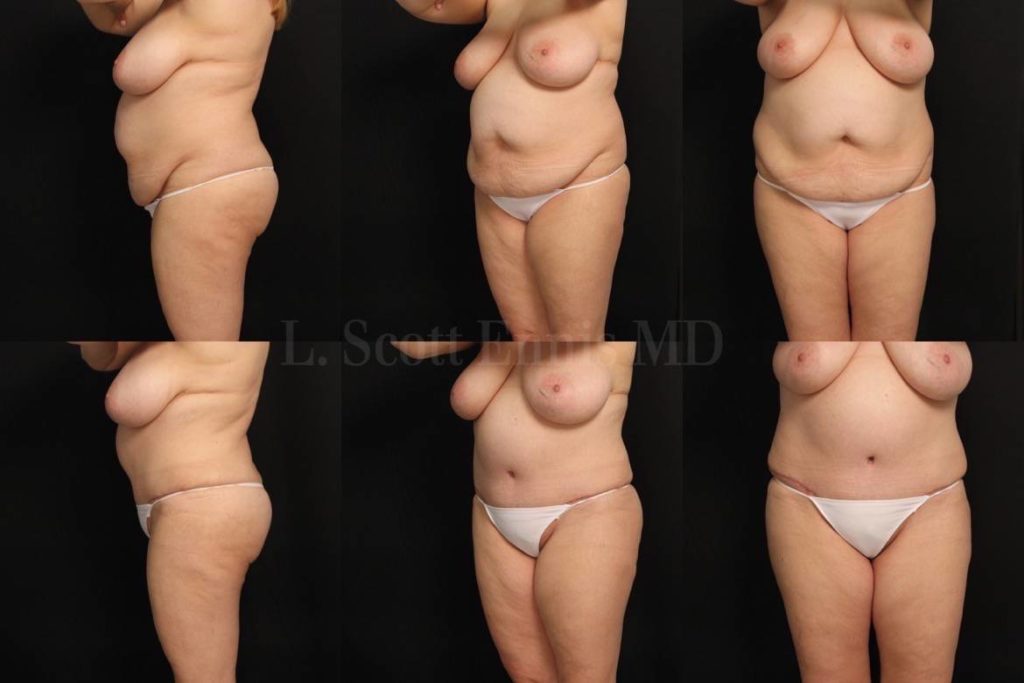 49yo 5'5'' 200lb Abdominplasty and Liposuction of Hips