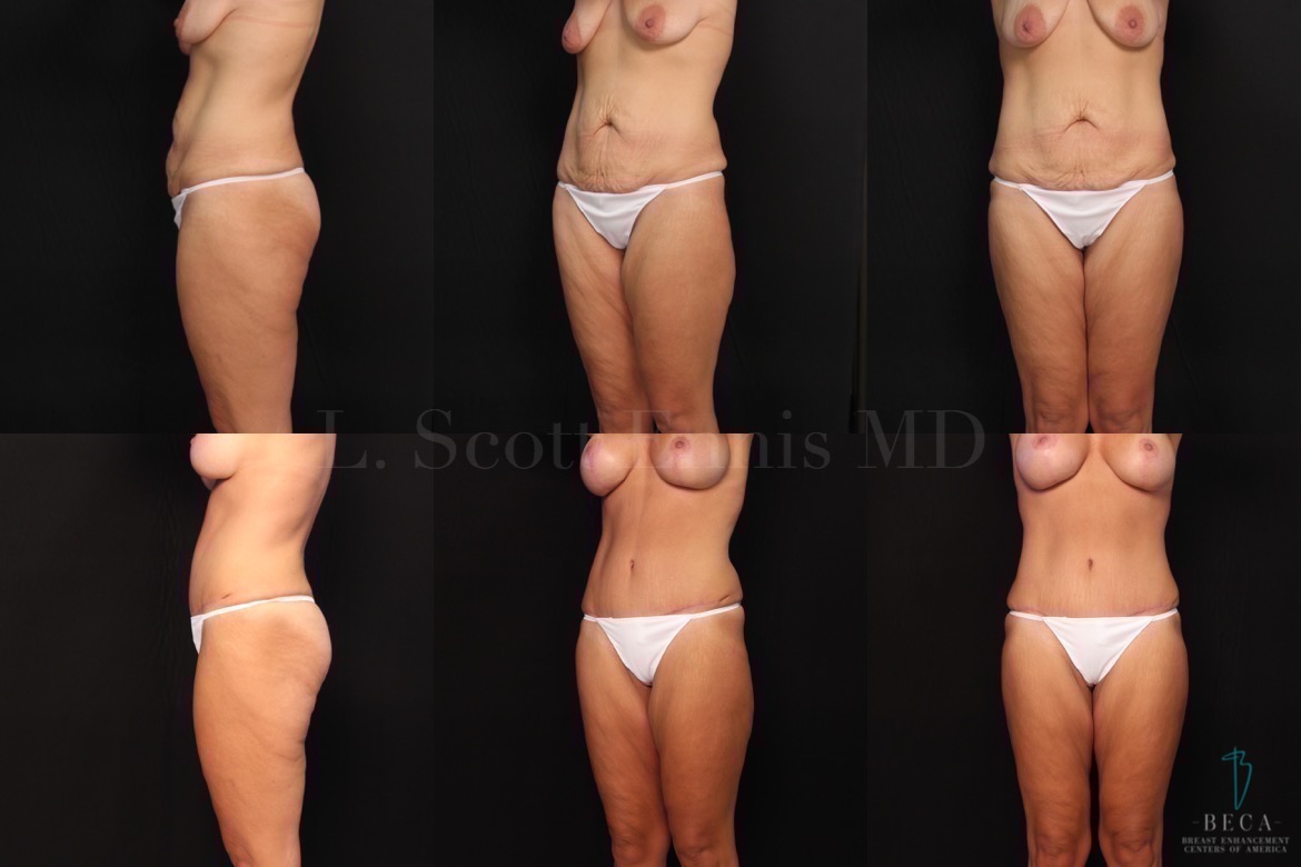 Tummy Tuck Before and After - BECA Centers