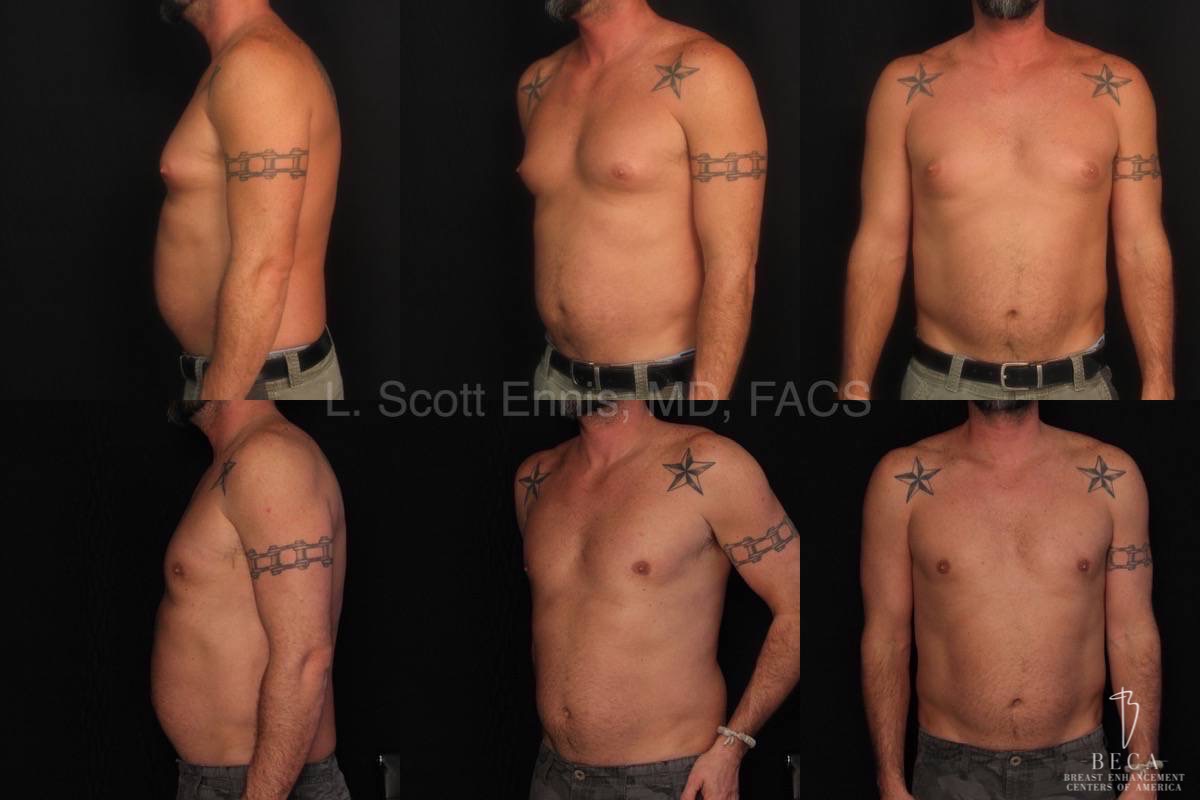 Gynecomastia and Liposuction of Chest – 856054