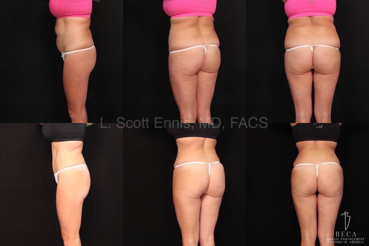 Abdominoplasty & Liposuction of Hips 1 – 22848